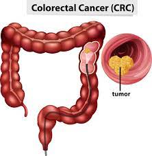 The importance of regulatory pathway mediated by Circ0001955 in colorectal cancer